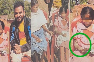 पत्थर शरीर वाली बच्ची के उपचार को लेकर बाल आयोग सक्रिय