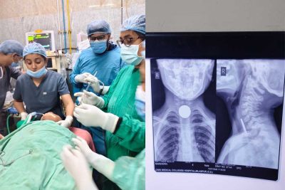 6 वर्षीय मासूम की आहार नली से सफलतापूर्वक निकाला गया सिक्का, बची जान