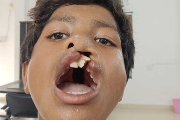 ‘चिरायु’ दल ने लौटाई मुस्कान, जन्मजात कटे होंठ और तालु से मिली मुक्ति